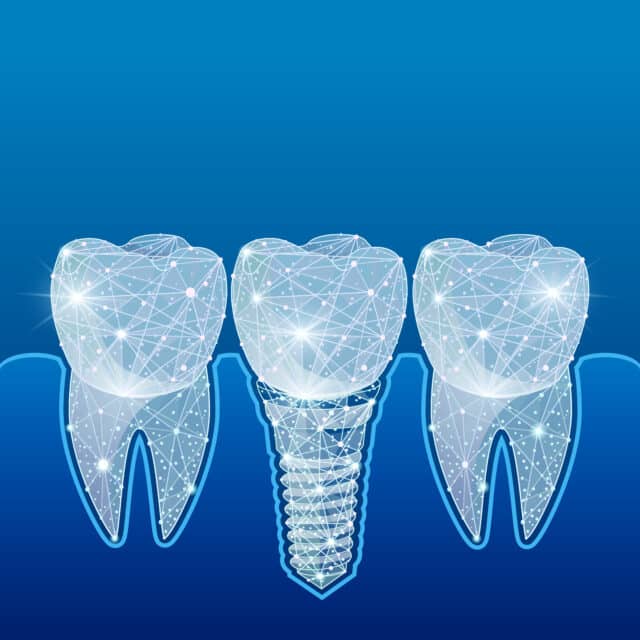 Aesthetic Dental Implants