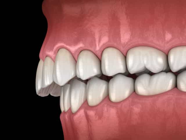 Correcting a class II malocclusion with orthodontics, is it possible?