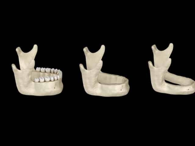 Why does missing teeth lead to dental bone loss?