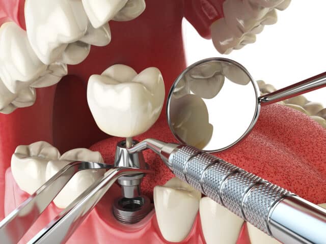 Dental Implant - Maxillofacial Surgery