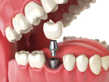 Dental Implant in Molars