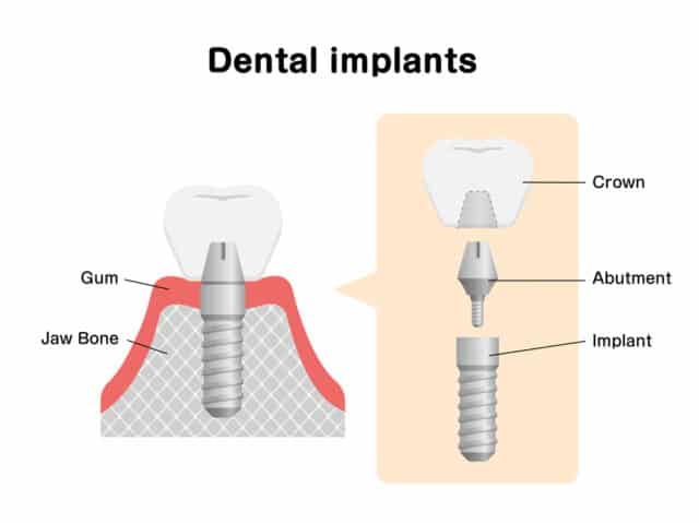 Dental Implant Parts
