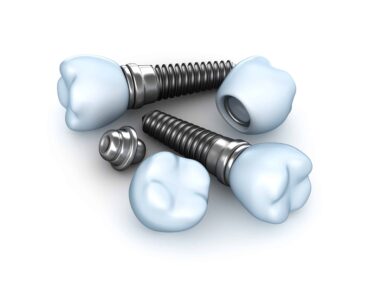 Dental implant brands