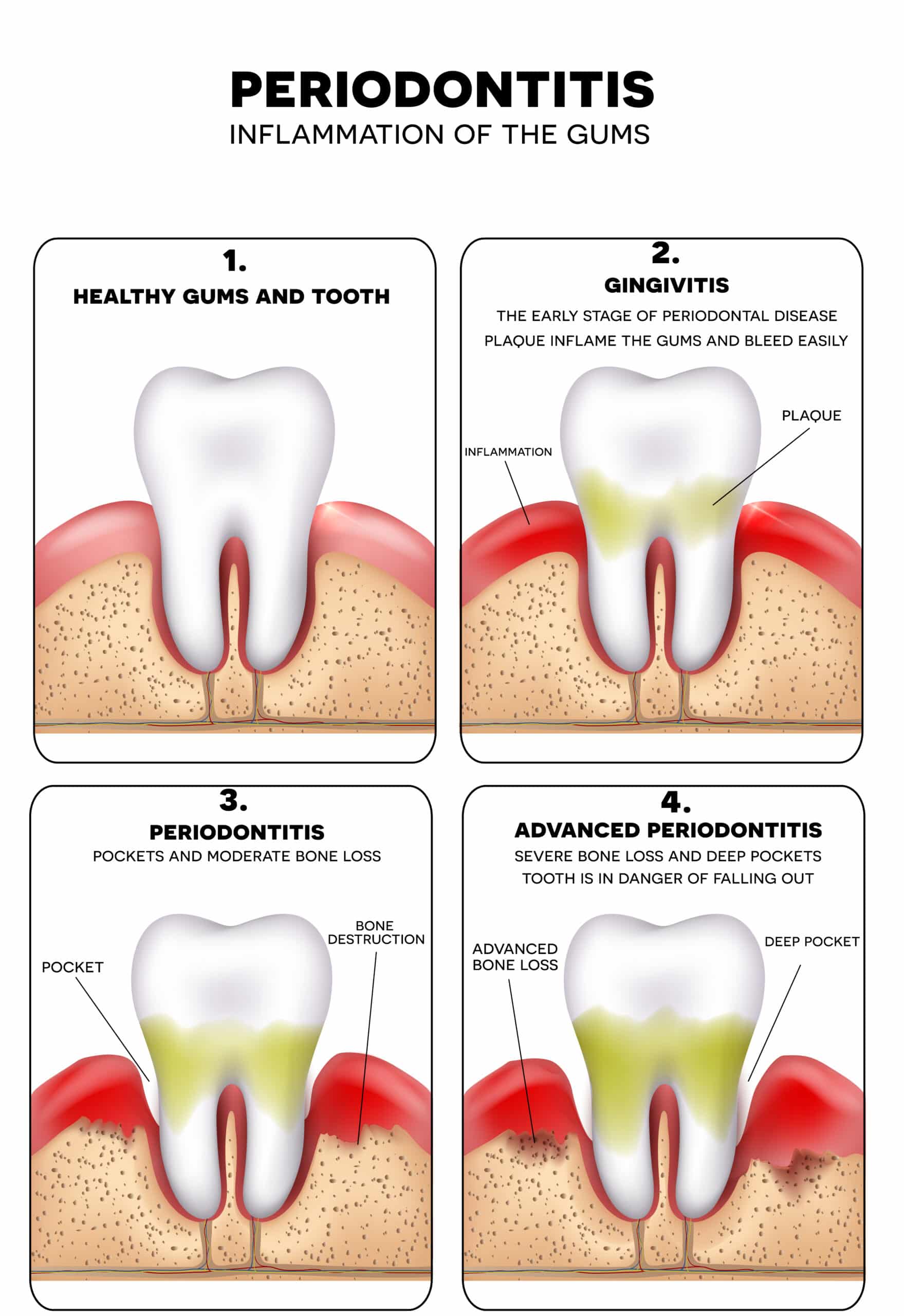 Gingivitis vs periodontitis