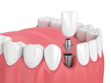 Immediate Load Dental Implants