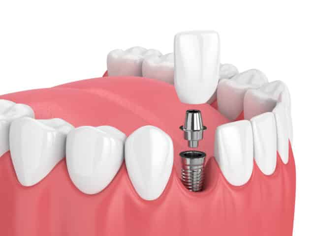 Immediate load dental implants: when is this technique performed?