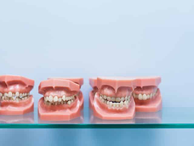 Malocclusion: Causes and Treatments to Correct it