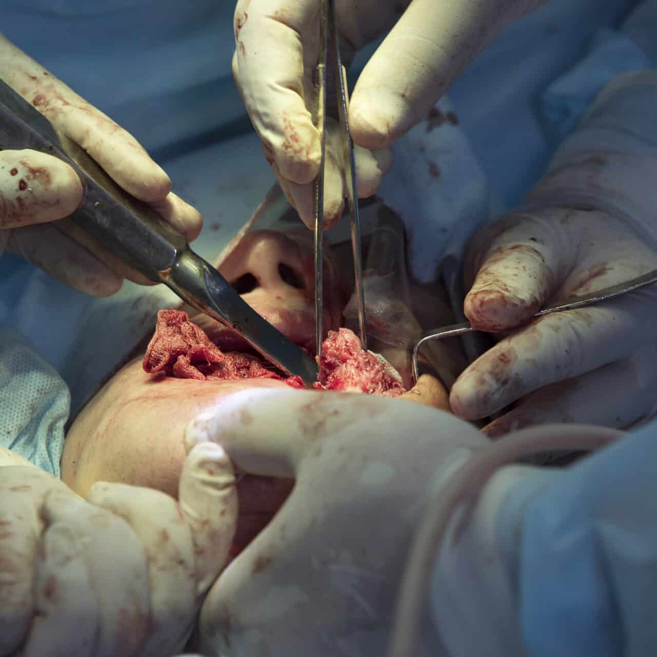 Orthognathic Surgery in Tijuana