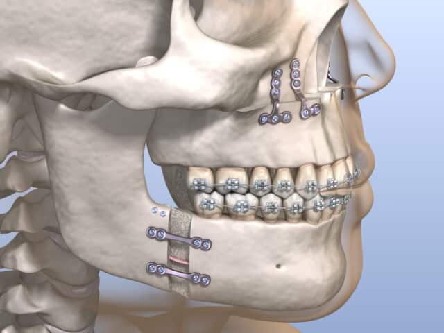 Jaw Surgery: the treatment step by step