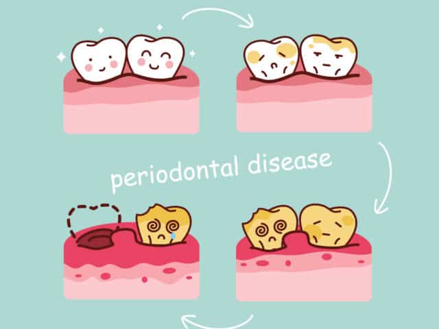 Periodontal Disease Treatment: how should it be performed? Does it cure pyorrhea for good?