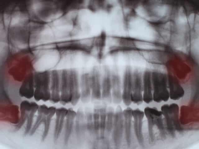 Wisdom teeth: guide to understanding what they are, when they appear and why to remove them