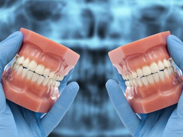 When Is Double Jaw Surgery Needed?