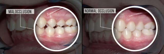 Normal Occlusion